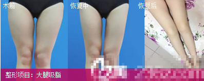 成都美黎美大腿吸脂术后对比照片