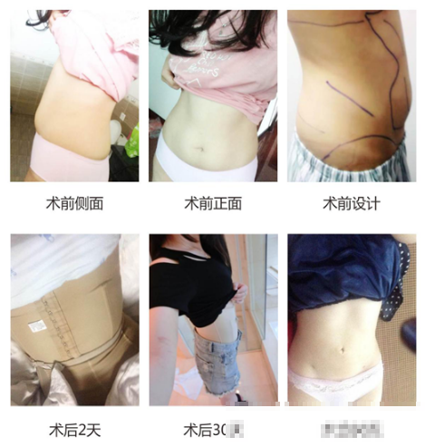 广州军美王娜医生腰腹部吸脂案例过程图