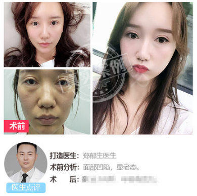 深圳恩吉娜郑郁生做的自体脂肪面部填充案例