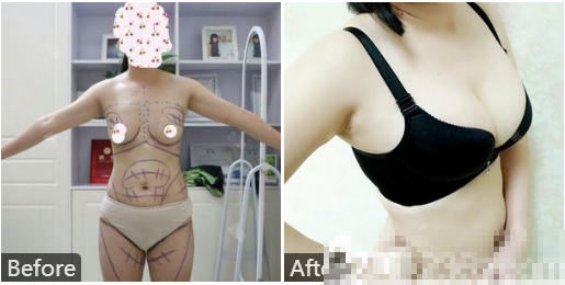 广州韩妃医疗整形美容医院曾繁茂自体脂肪隆胸案例