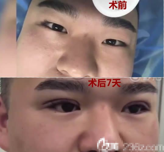 福州超美整形眼综合术后7天对比效果