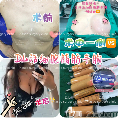 惠州刘伟勇医疗美容诊所整形医生刘伟勇做的隆胸案例