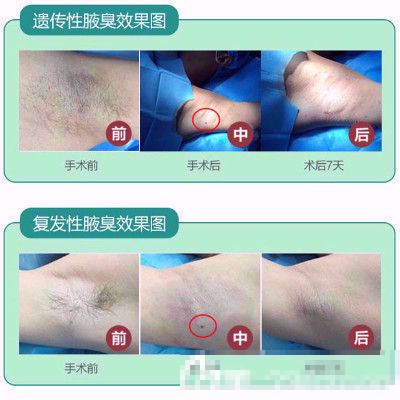 广州肤康皮肤科医院腋臭治疗案例