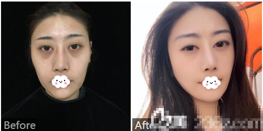 广州澳玛星光医疗美容王冠射频溶脂瘦脸案例