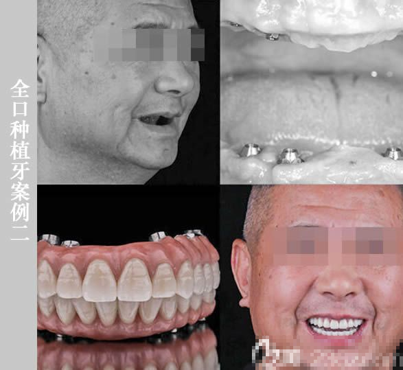 64岁陈先生在维乐做完全口即刻种植牙的对比效果