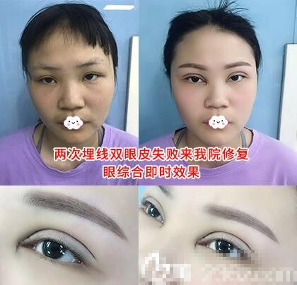 2次埋线双眼皮失败到阜阳皇宫雕美做眼综合修复术