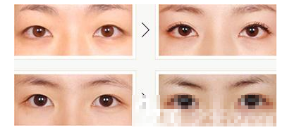 南京中美医疗美容诊所双眼皮案例