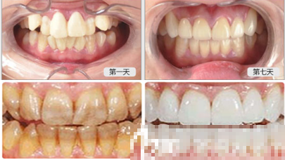 找合肥美奥口腔医院做全瓷美观牙案例前后对比图