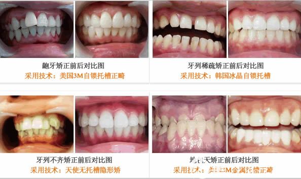 成人龅牙矫正和牙齿稀疏矫正等案例效果图