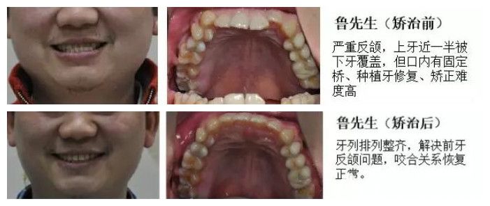 上海臻威口腔严重地包天的鲁先生牙齿矫正效果对比图