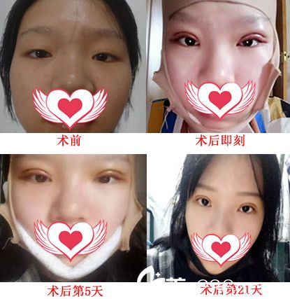 安徽合肥新地整形案例：面颊部吸脂塑形+切开双眼皮21天恢复过程图