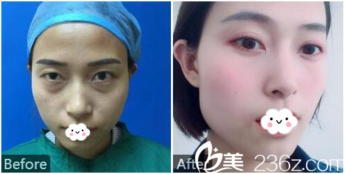 广州凯美达医疗美容整形医院双眼皮祛眼袋案例
