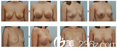 珠海九龙医院整形美容科隆胸案例图