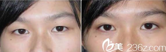 福州伊薇全切双眼皮整形案例及术后三个月对比图