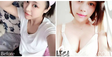  深圳和美医疗美容医院潘华自体脂肪隆胸案例图