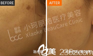 深圳小珂丽格超皮秒治疗光老化斑案例图片