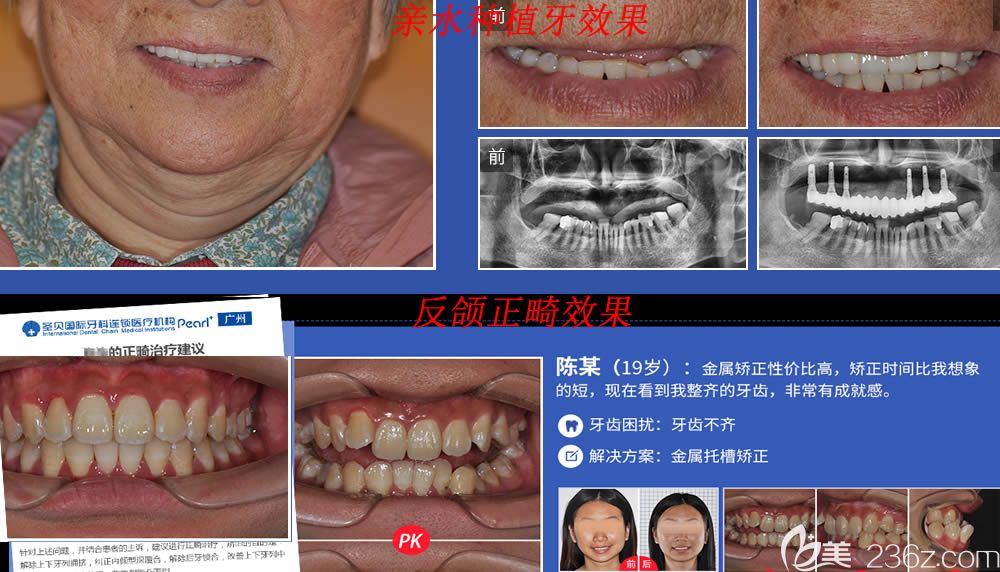 广州圣贝口腔种植牙和牙齿正畸案例效果图