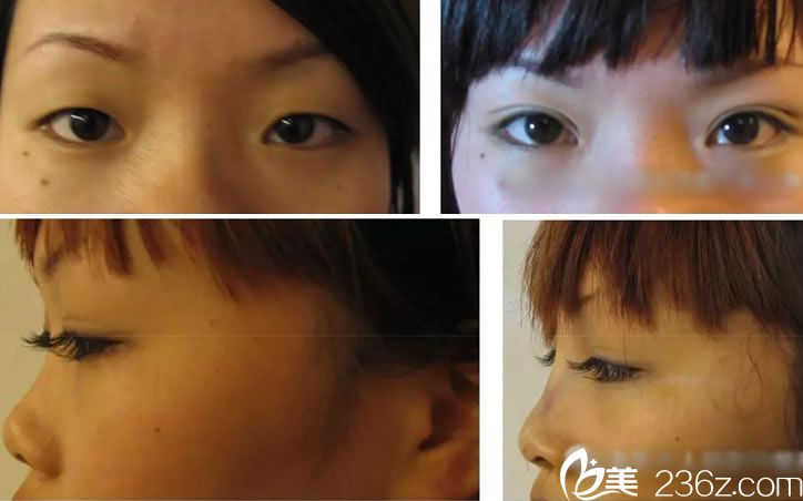 金华市人民医院整形美容科双眼皮和隆鼻案例