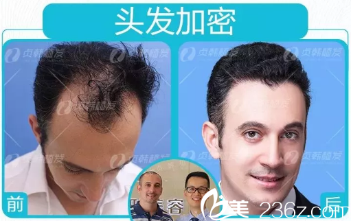 广西南宁贞韩医院做头发加密种植的案例
