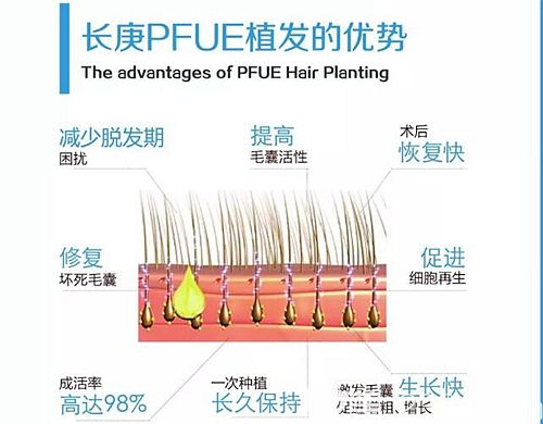 合肥长庚采用先进的PFUE植发技术