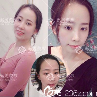 深圳弘美医疗美容整形医院双眼皮案例对比图