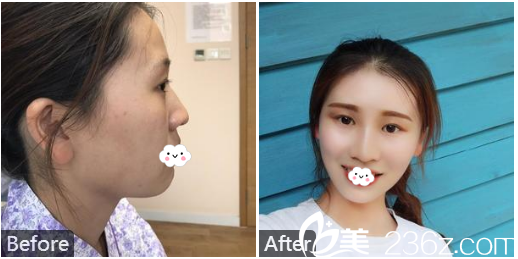 广州澳玛星光医疗美容王冠玻尿酸隆鼻案例