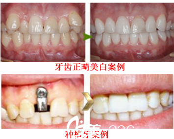 在六安伊而美做牙齿正畸和种植牙案例前后效果对比