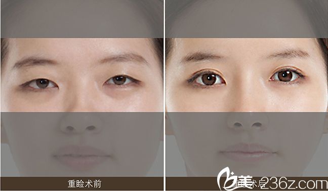 连云港国泰整形美容外科诊所双眼皮整形案例