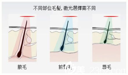 激光脱毛的部位