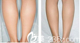 北京美娇医疗美容医院瘦小腿案例