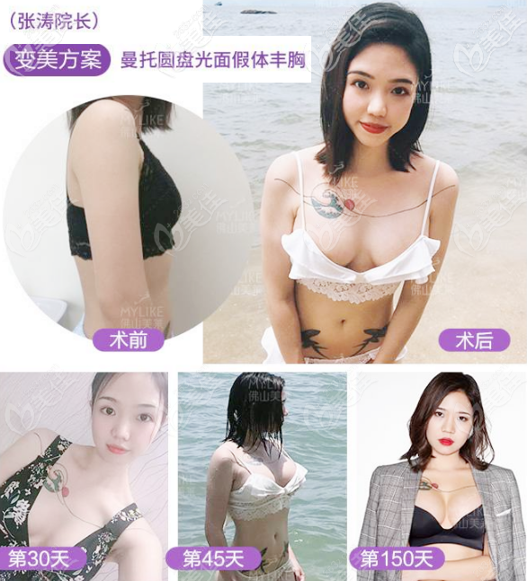 佛山美莱张涛院长曼托假体隆胸案例