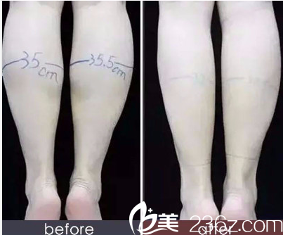 北京斯迈尔医疗美容诊所瘦腿案例