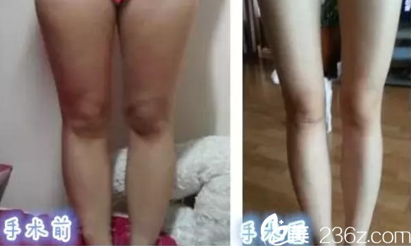 北京麦西美嘉腿部吸脂案例