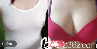 北京美联和谐医疗美容门诊部脂肪丰胸案例