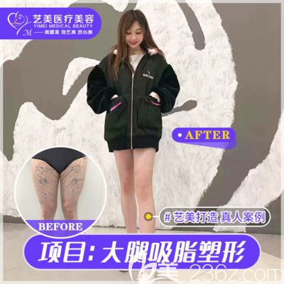 广州艺美整形李向阳大腿吸脂案例