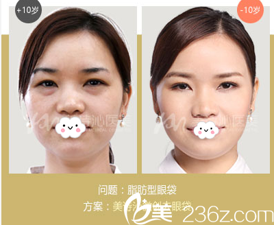 广州美诗沁医疗美容医院20分钟微创祛眼袋案例