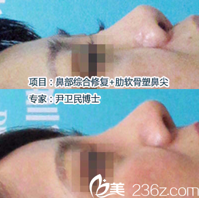 深圳广和尹卫民做的鼻综合隆鼻失败修复案例