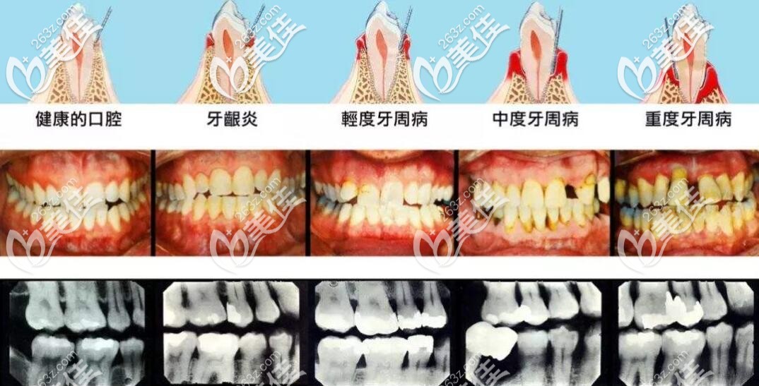 牙周炎的发展过程