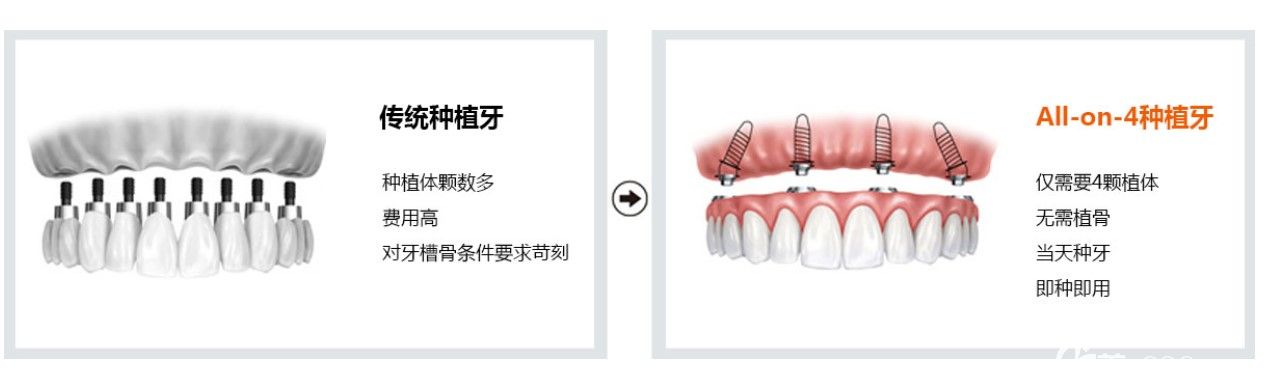 all-on-4即刻种植牙技术