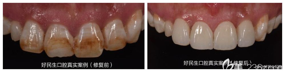 中山好民生口腔氟斑牙采用超薄牙贴面修复案例