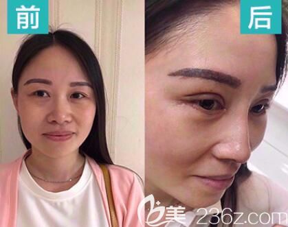 贵阳美杜莎元辰隆鼻案例