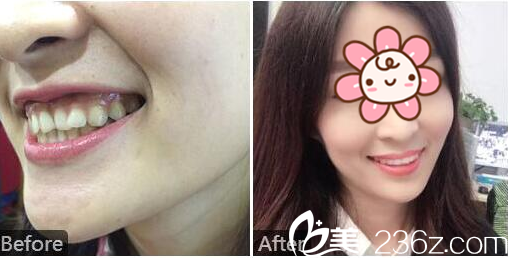 广州雅度口腔医院隐形托槽牙齿矫正案例
