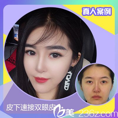 深圳嘉美医疗美容肖添有双眼皮案例