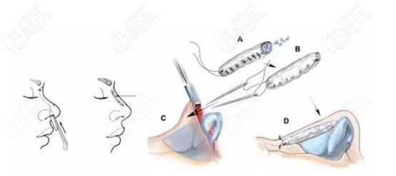 沈正洲肋软骨隆鼻手术示意图
