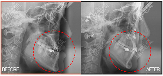 周会喜正颌手术案例术后拍片效果
