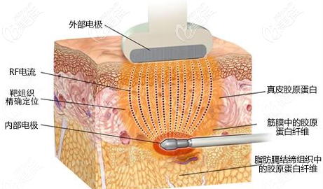 bodytite溶脂原理