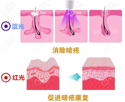 红蓝光祛痘作用原理示意图