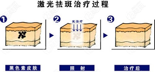 激光祛斑治疗过程图