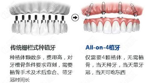ALL-ON-4种植技术与传统种植牙的区别