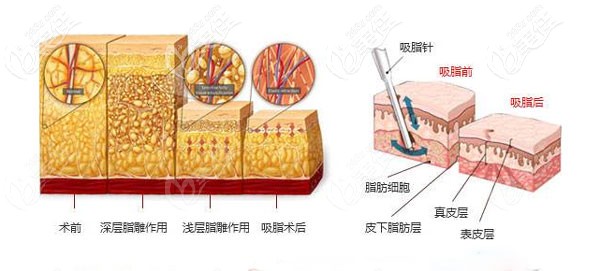 庄蔚强院长做吸脂手术的5大技术优势